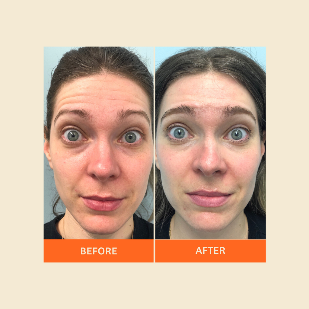 Botox Cosmetic Results